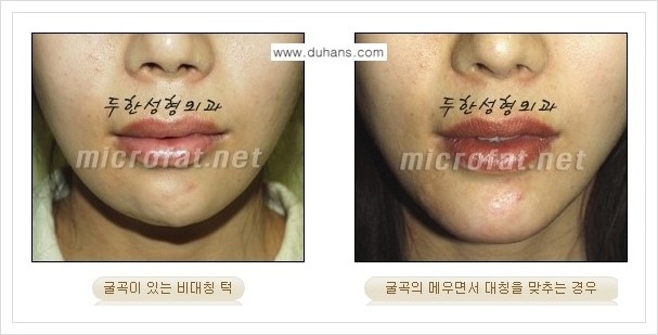 [두한성형외과의 경쟁력 미세지방이식] - [무턱교정, 턱 미세지방이식 안내 1.] 관련 이미지 4