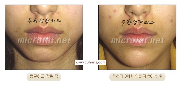 [두한성형외과 경쟁력 미세지방이식] - [부드럽고 아름다운 얼굴윤곽선 턱(하악부) 미세지방이식 안내] 관련 이미지 14