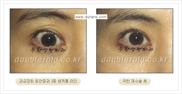 [두한성형외과 경쟁력 쌍꺼풀 재수술] - [극한의 상태에서 쌍꺼풀 재수술 안내 ②] 관련 이미지 6