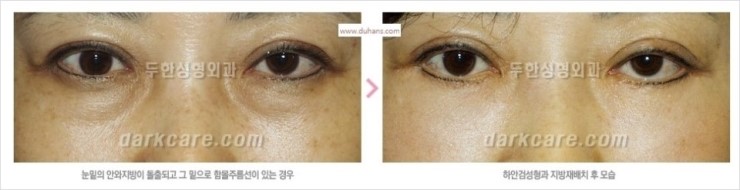 [두한성형외과 경쟁력 눈밑성형] - [다크써클의 모든 것] 관련 이미지 30