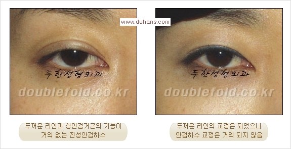 [두한성형외과 경쟁력 쌍꺼풀 재수술, 극한 재수술] - [쌍꺼풀 재수술에서 극복해야 할 극한의 상황과 문제들] 관련 이미지 16