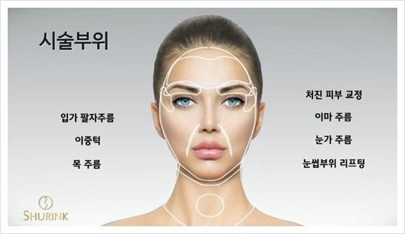 [두한성형외과 경쟁력 주름성형] - [주름제거를 위한 리프팅] 관련 이미지 32