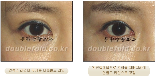 두한성형외과 쌍커풀 재수술 - 눈매교정 재수술 관련 이미지 68