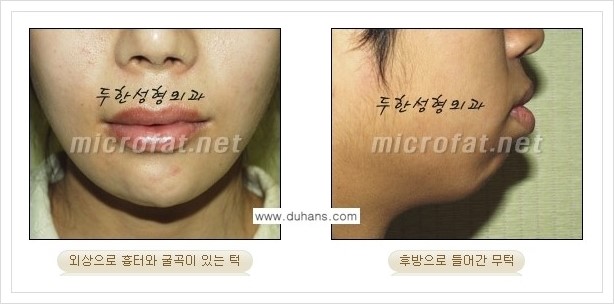 [두한성형외과 경쟁력 미세지방이식] - [얼굴 윤곽 무턱교정 안내 ①] 관련 이미지 4