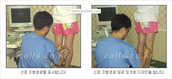 ⁠⁠[두한성형외과 경쟁력 종아리성형] - [굵은 다리의 모양과 원인에 따른 종아리성형 방법] 관련 이미지 3