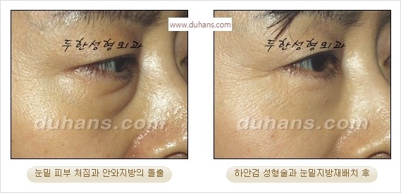 [두한성형외과 경쟁력 안검성형] - [눈밑주름 제거수술] 관련 이미지 22