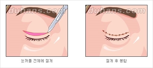 [두한성형외과 경쟁력 눈성형] - [자연스럽고 아름다운 눈매를 위한 쌍꺼풀 수술 ①] 관련 이미지 2