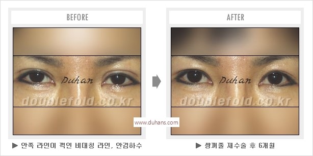 [두한성형외과 경쟁력 눈성형] - [나에게 맞는 어울리는 쌍꺼풀 라인] 관련 이미지 34