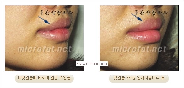 [두한성형외과 경쟁력 미세지방이식] - [입술 3차원 입체지방이식 안내 2.] 관련 이미지 4