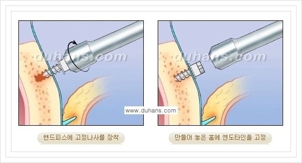 [두한성형외과 경쟁력 주름성형] - [눈썹거상, 앞볼처짐 개선의 엔도타인 리프팅] 관련 이미지 10