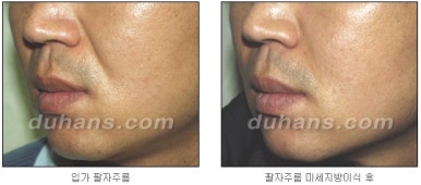 [두한성형외과 주름교정] - [지방이식을 이용한 주름개선] 관련 이미지 20