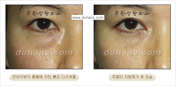 [두한성형외과 젊은 눈매 안검성형] - [눈밑 지방제거의 수술 전후 안내 ②] 관련 이미지 2