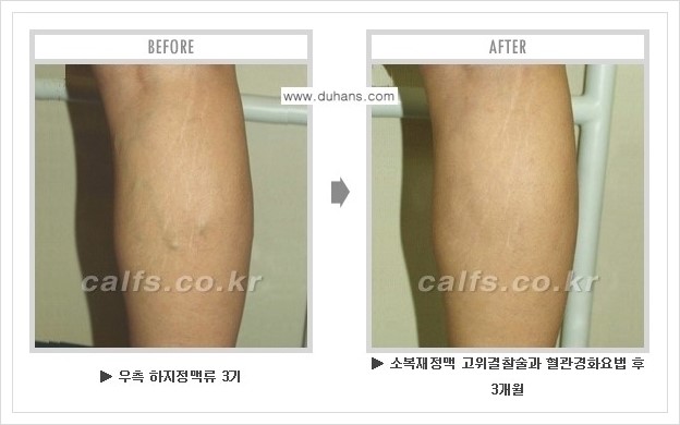 [두한성형외과 경쟁력 정맥류 치료] - [하지정맥류 사진 자료 안내 1.] 관련 이미지 7
