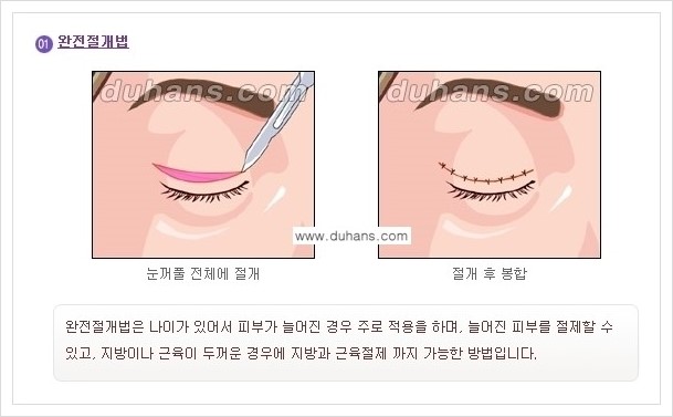 [두한성형외과 경쟁력 눈성형] - [아름답고 자연스러운 눈매를 위한 퀵쌍꺼풀 안내] 관련 이미지 3