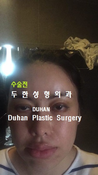[두한성형외과 쌍커풀 재수술] - [재수술 실패의 원인, 나에게 맞는 쌍커풀] 관련 이미지 32