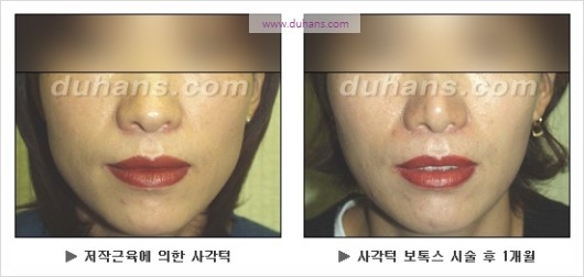 [두한성형외과 경쟁력 안면윤곽 성형 리더] - [완변한 V 라인! 턱 미세지방이식, 볼살 미세지방이식, 사각턱 보톡스 안내] 관련 이미지 32