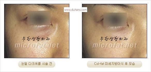 [두한성형외과 경쟁력 눈밑성형] - [다크써클 치료 전후 관리사항] 관련 이미지 20