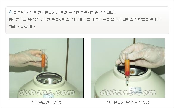 [두한성형외과 경쟁력 주름성형] - [주름 교정을 위한 안전하고 효과적인 미세지방이식] 관련 이미지 3