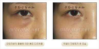 두한성형외과 눈밑수술 - 다크서클 수술 전후 관리 안내 관련 이미지 76