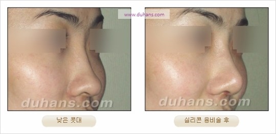 [두한성형외과 경쟁력 코성형 리더] - [자연스럽고 오똑한 콧망울! 코성형 방법]​ 관련 이미지 19