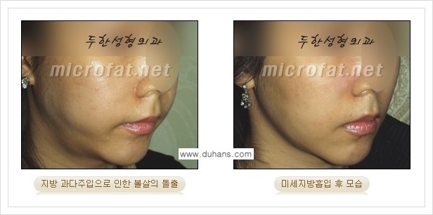[두한성형외과 경쟁력 지방이식] - [지방이식 부작용 - 지방이식 후 지방이식 과다주입, 과다생착의 교정 안내] 관련 이미지 2