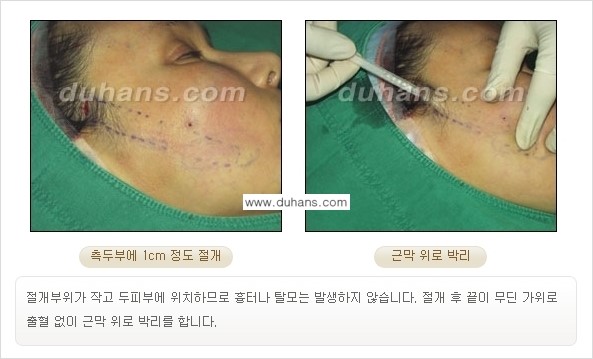 [두한성형외과 젊어지는 주름교정술] - [주름제거 시술방법 ②] 관련 이미지 9