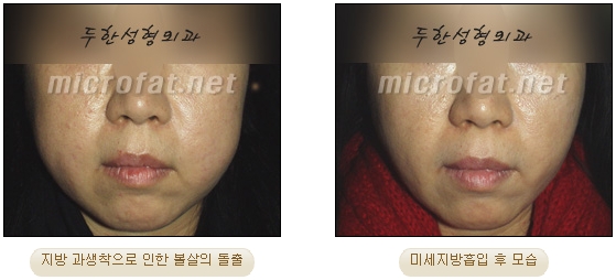 [두한성형외과 지방이식] - [타병원의 지방이식 부작용 교정] 관련 이미지 27
