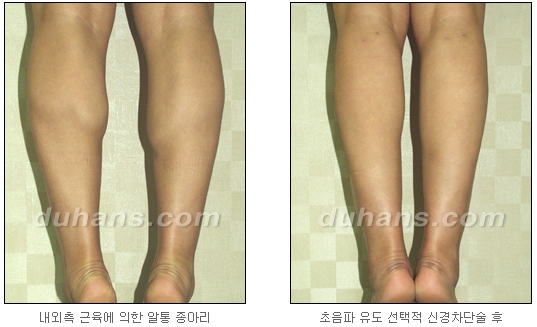 [Duhan Plastic Surgery Calf Reduction] - [How to Get Rid of Calf Muscle Bulges] image 22