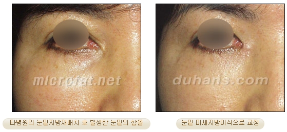 두한성형외과 지방제거 - 눈밑지방, 눈꺼풀지방제거 관련 이미지 57