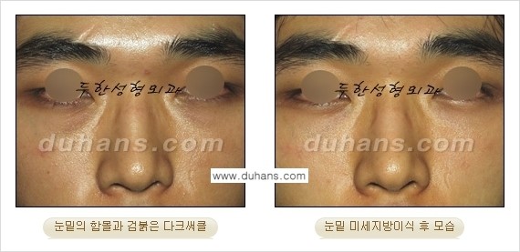 [두한성형외과 상큼하고 환한 눈매완성] - [눈밑 미세지방이식 ①] 관련 이미지 17
