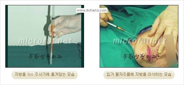 [두한성형외과 경쟁력 주름성형] - [코 옆과 입가에 걸쳐서 형성된 주름을 교정해주는 미세지방이식] 관련 이미지 5
