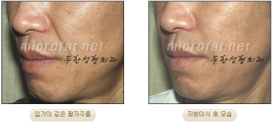 [Duhan Plastic Surgery Face Fat Grafting] - [Reducing Mouth Corners Wrinkles and Nasolabial Folds] image 8