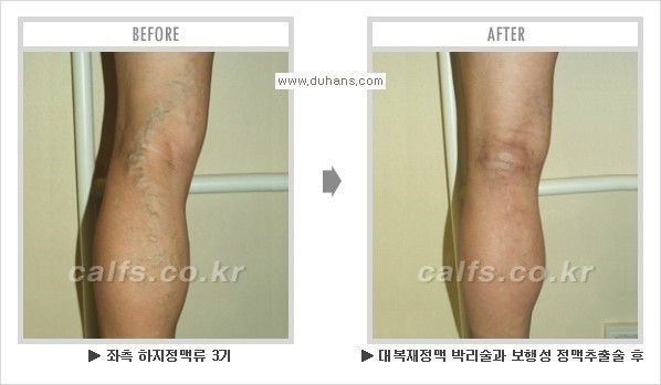 [두한성형외과 경쟁력 멀티종아리성형] - [지방흡입이 필요한 종아리 비만 안내] 관련 이미지 21
