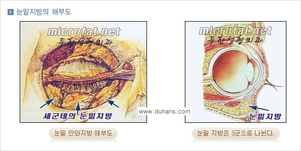[두한성형외과 경쟁력 "지방제거"] - [눈 지방제거 1.] 관련 이미지 5