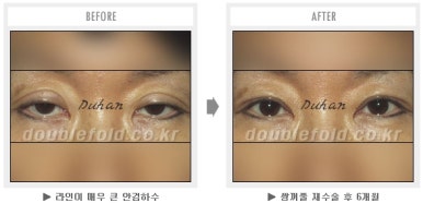 두한성형외과 쌍커풀 재수술 - 짝눈 눈매교정, 가성 안검하수 교정과 뒤밑트임 관련 이미지 38