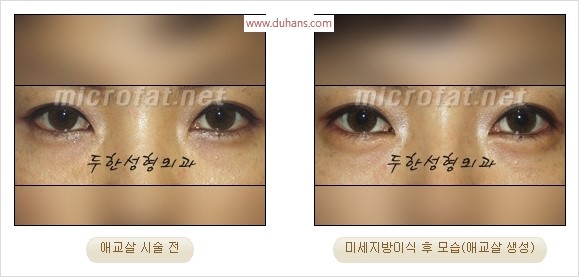 ​﻿[두한성형외과 경쟁력 지방이식] - [눈밑 애교살 시술을 위한 미세지방이식] 관련 이미지 45