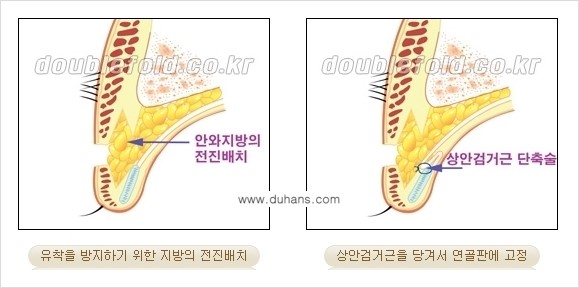 [두한성형외과 경쟁력 눈성형] - [안검하수(졸린 눈매) 재수술 안내 ②] 관련 이미지 7