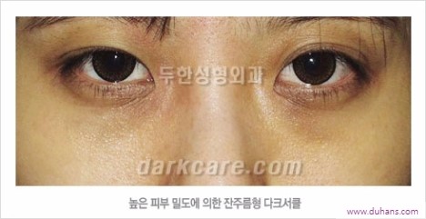 [두한성형외과 경쟁력 눈밑성형] - [하안검성형(눈밑주름제거술)과 눈밑지방재배치안내] 관련 이미지 4