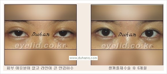 [두한성형외과 경쟁력 눈성형] - [안검하수와 몽고주름에 대한 자주하는 질문과 답변] 관련 이미지 6