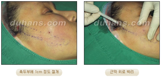 두한성형외과 안티에이징 리프팅 - 엔도타인 리프팅 관련 이미지 11