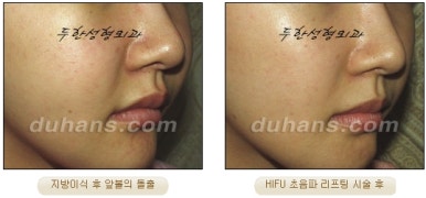 두한성형외과 주름개선 - 주름 HIFU 리프팅 관련 이미지 17