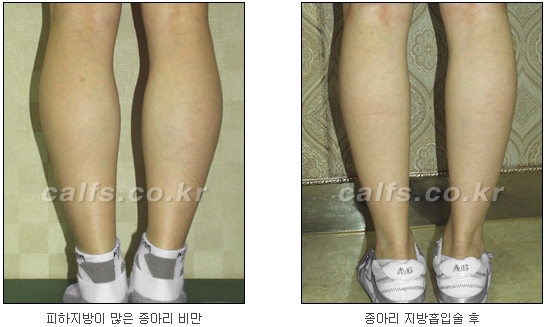 두한성형외과 지방흡입 - 부위별 안전 지방흡입 관련 이미지 37