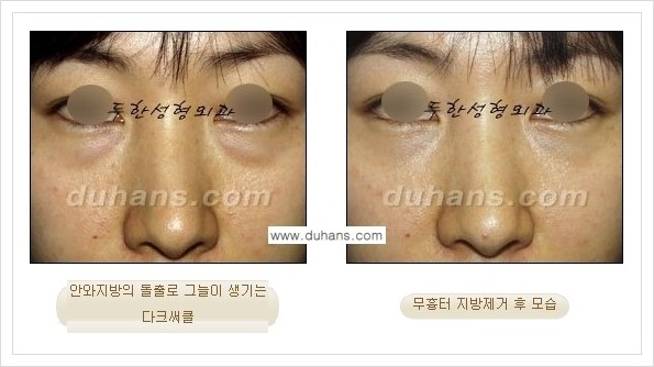[두한성형외과 경쟁력 안검성형] - [눈밑 지방제거 안내] 관련 이미지 3