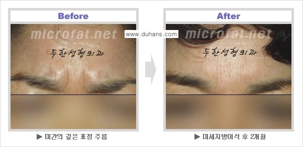[두한성형외과 NO 1. "Col-fat 지방이식"] - [지방이식의 지속효과, 오해와 진실, 부작용] 관련 이미지 3