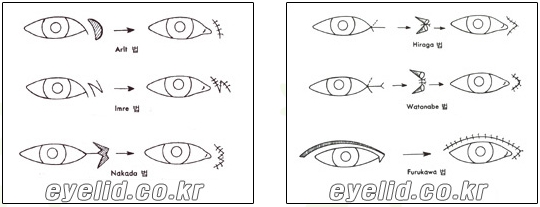 [Duhan Plastic Surgery Eyelid Surgery] - [Epicanthoplasty, Medial Canthoplasty] image 6
