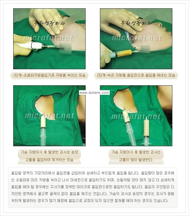 [두한성형외과 경쟁력 지방이식] - [지방이식 부작용 교정 안내 2.] 관련 이미지 3