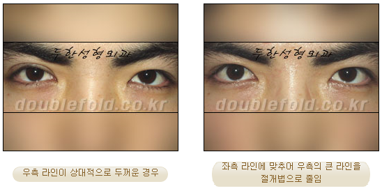 [두한성형외과 쌍커풀수술] - [눈성형 방법에 대한 자주하는 질문과 답변] 관련 이미지 43