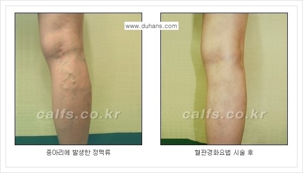 [두한성형외과 경쟁력 멀티종아리성형] - [나에게 맞는 종아리성형 방법의 종류 안내 3.] 관련 이미지 12