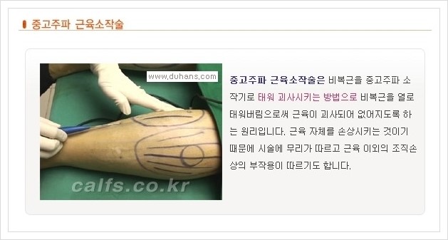 [두한성형외과 경쟁력 멀티종아리성형] - [날씬한 종아리를 만드는 다양한 시술방법의 장점, 단점 안내] 관련 이미지 5