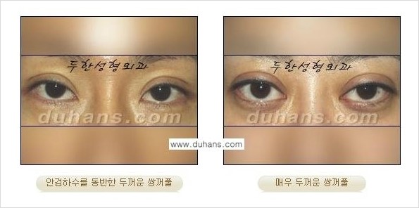 [두한성형외과 경쟁력 쌍꺼풀 재수술, 극한 재수술] - [두꺼운 쌍꺼풀 라인의 교정 방법 안내] 관련 이미지 2